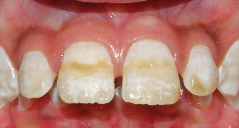Черный налет на зубах: методы лечения